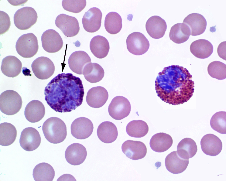 Leucociti valori alti e bassi: cosa significa?