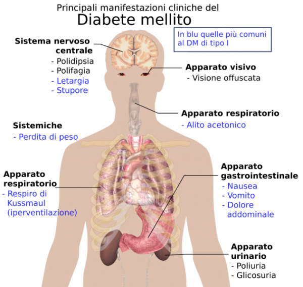 632px-Principali_manifestazioni_cliniche_diabete-600×569