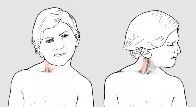 Distonia sintomi cause e rimedi