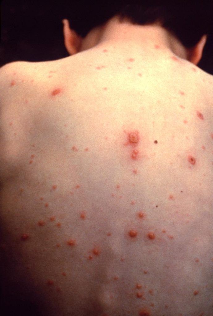 Varicella: quello da sapere sulla malattia esantematica dei bambini