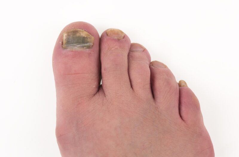 Onicomicosi cause rimedi