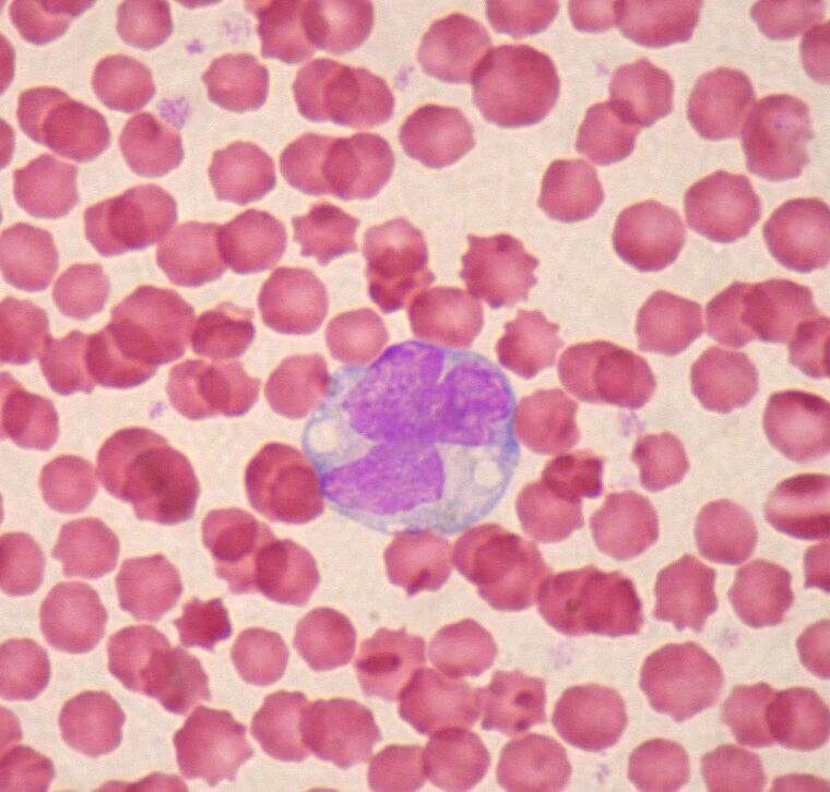 Galleria foto - Globuli bianchi bassi: da cosa dipendono e quando preoccuparsi Foto 2