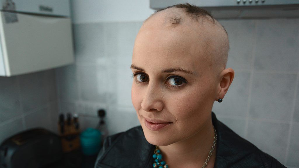 Galleria foto - Alopecia: cause, sintomi e cure di una patologia che colpisce all’improvviso Foto 2