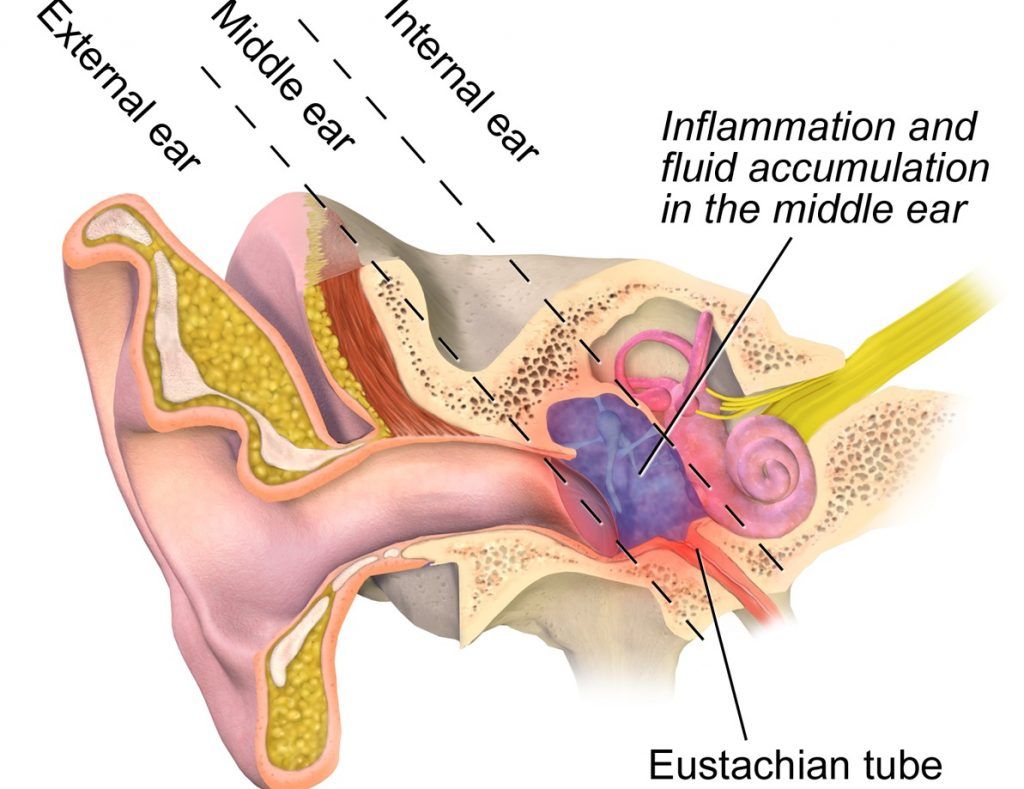 Otite: cause, sintomi, cura e rimedi naturali