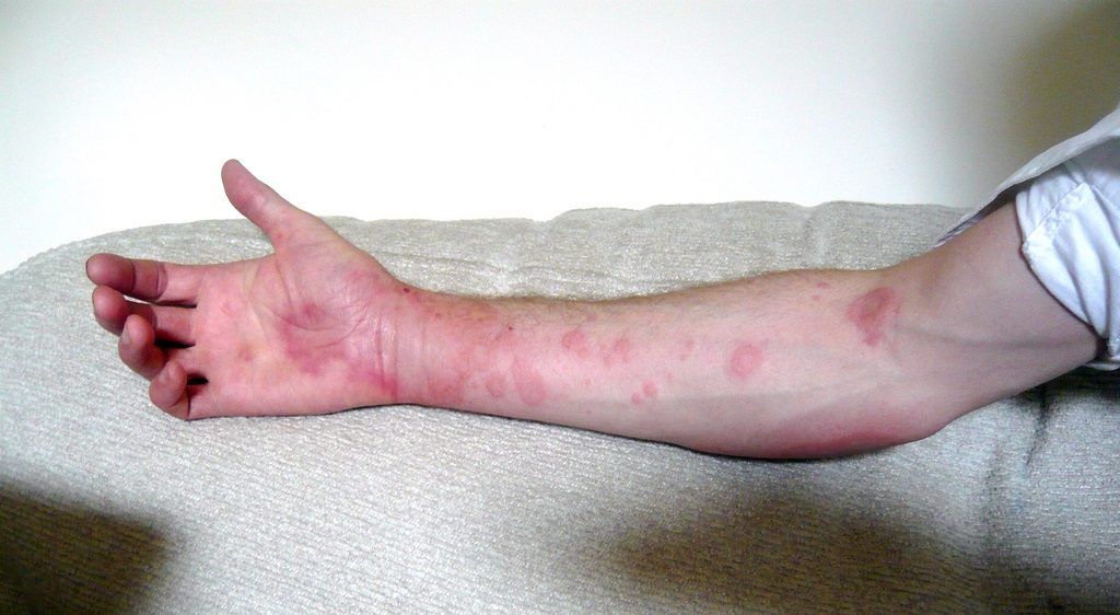 Galleria foto - Macchie rosse sulla pelle: le cause in adulti e bambini Foto 4