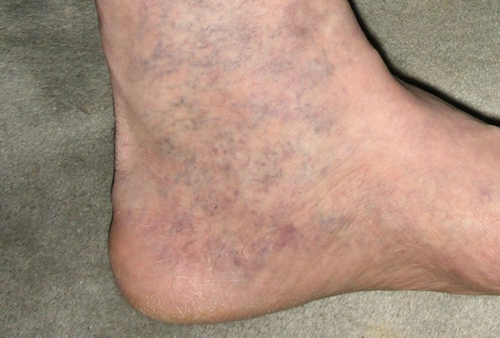 Galleria foto - Daflon: un farmaco efficace per vene varicose ed emorroidi Foto 2