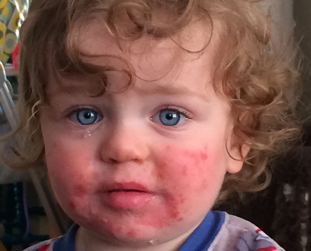 Galleria foto - Quinta Malattia: cause, sintomi e contagio in adulti e bambini Foto 2