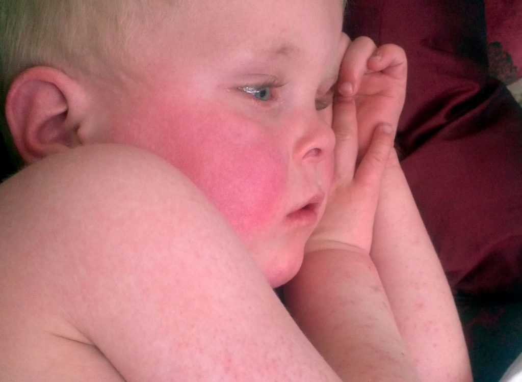 Galleria foto - Malattie Esantematiche in adulti e bambini: come riconoscerle e curarle Foto 1