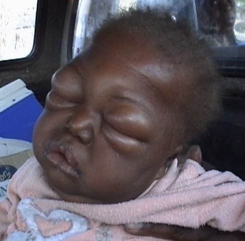 Galleria foto - Tiorfix: un farmaco efficacie per trattare la diarrea nei bambini Foto 2