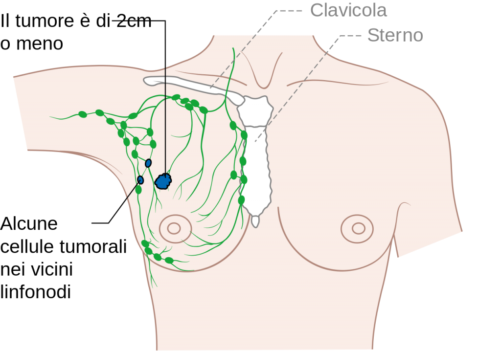 Galleria foto - Linfonodi reattivi, quali possono essere le cause Foto 3