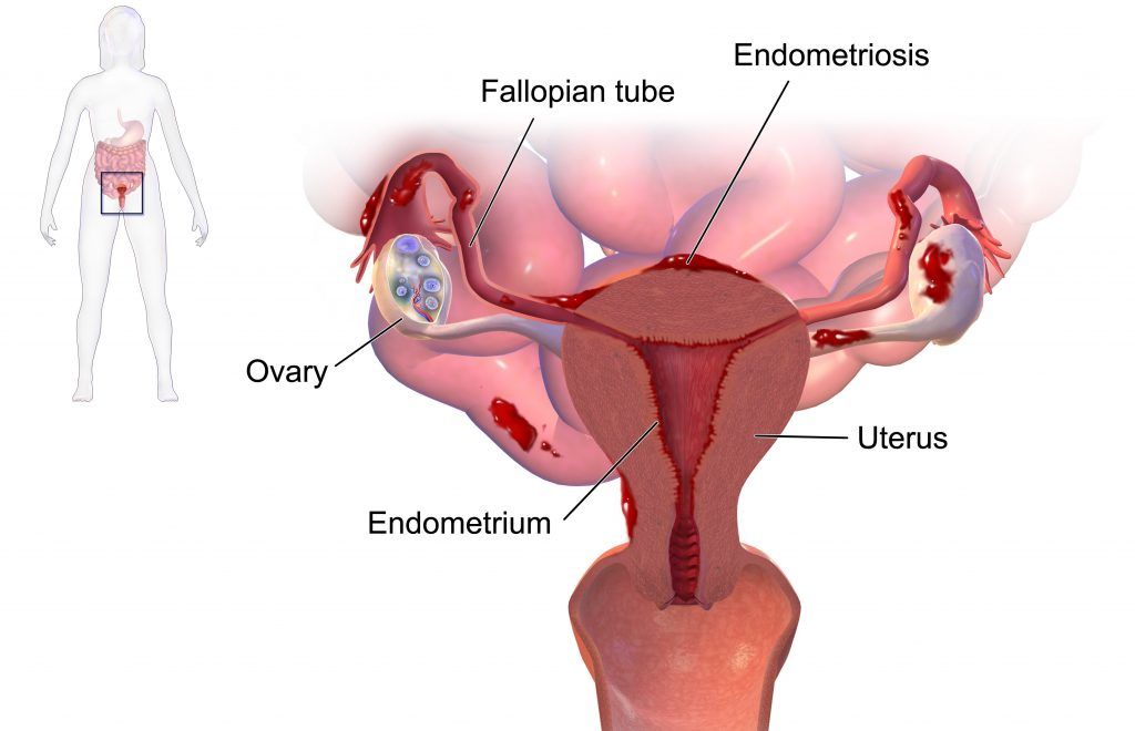 Endometriosi: cause, sintomi, terapie e complicazioni