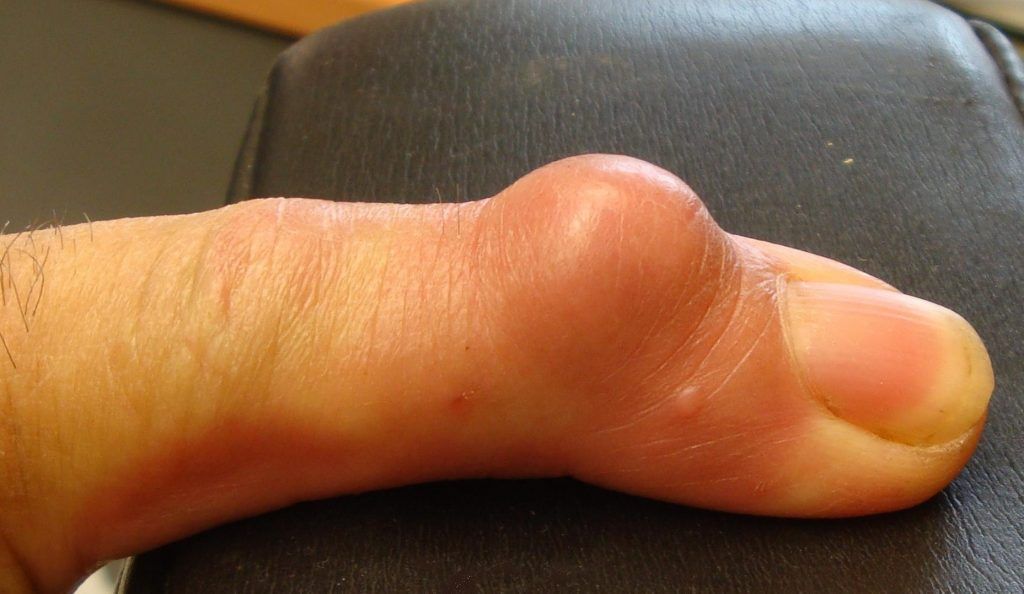 Lipoma: cause, sintomi e terapie in adulti e bambini