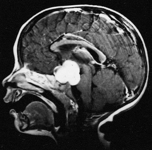 Galleria foto - Prolattina Alta: cause, sintomi e cure per l’iperprolattinemia Foto 1