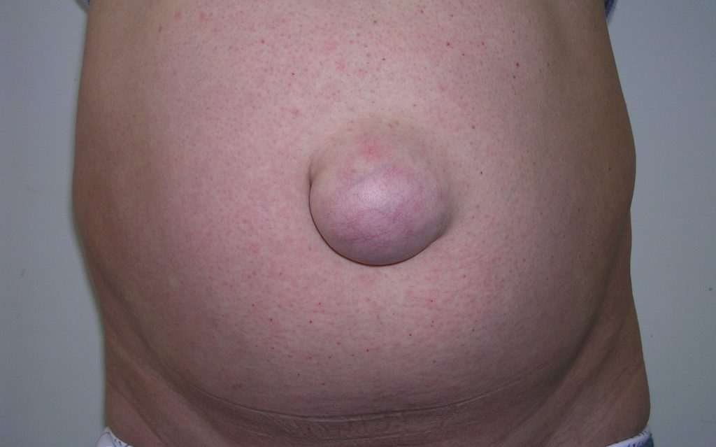 Ernia Ombelicale: cause, sintomi e quando operare in adulti e bambini