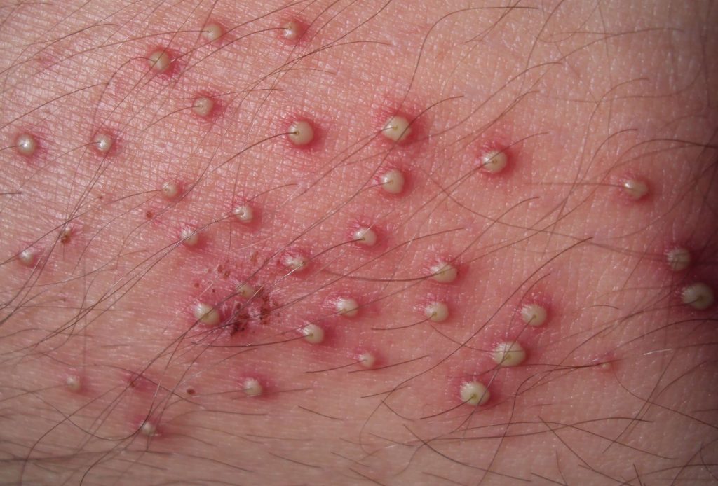 Follicolite: cause, sintomi e cure in adulti e bambini