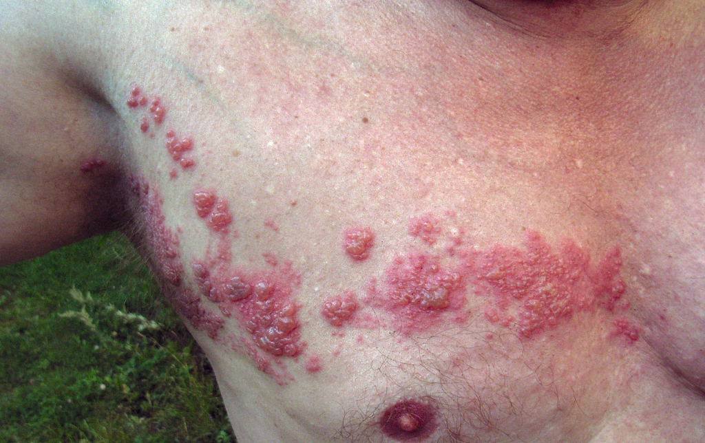 Pityriasis versicolor: cause e rimedi di questa malattia cutanea