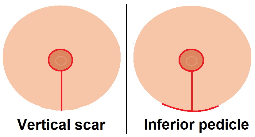 Galleria foto - Intervento di Mastoplastica Riduttiva: procedura, rischi, costi e cose da sapere Foto 2