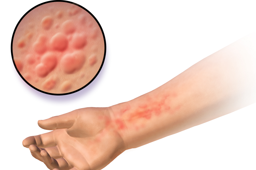 Shock Anafilattico: cause, sintomi, terapia e pericoli