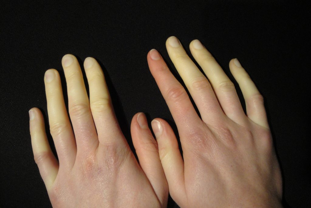 Sindrome di Raynaud: cause, sintomi ed esami diagnostici
