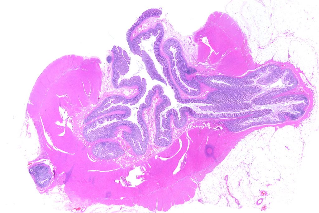Diverticoli del colon: cosa sono e quali sono i sintomi della diverticolite