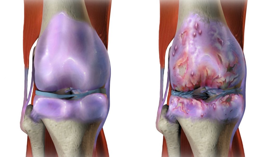 Artrosi: cause, sintomi, cure naturali e tutte le informazioni utili