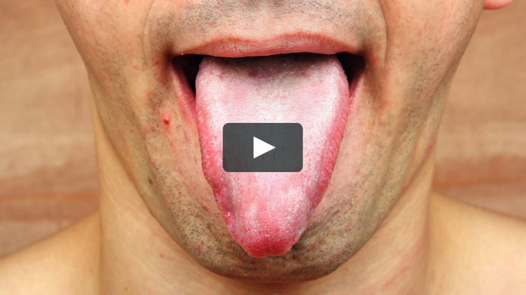 Lingua Bianca: tutte le possibili cause ed i rimedi della nonna efficaci