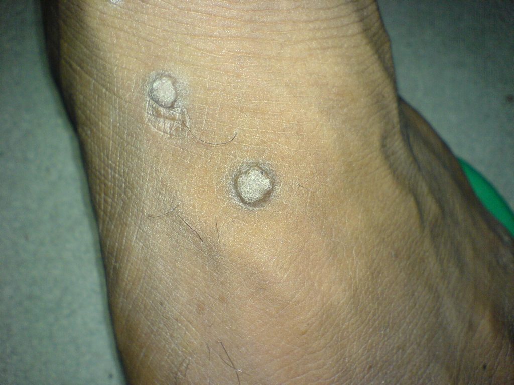 Verruche: cosa sono, come si riconoscono, diagnosi, cause e terapie
