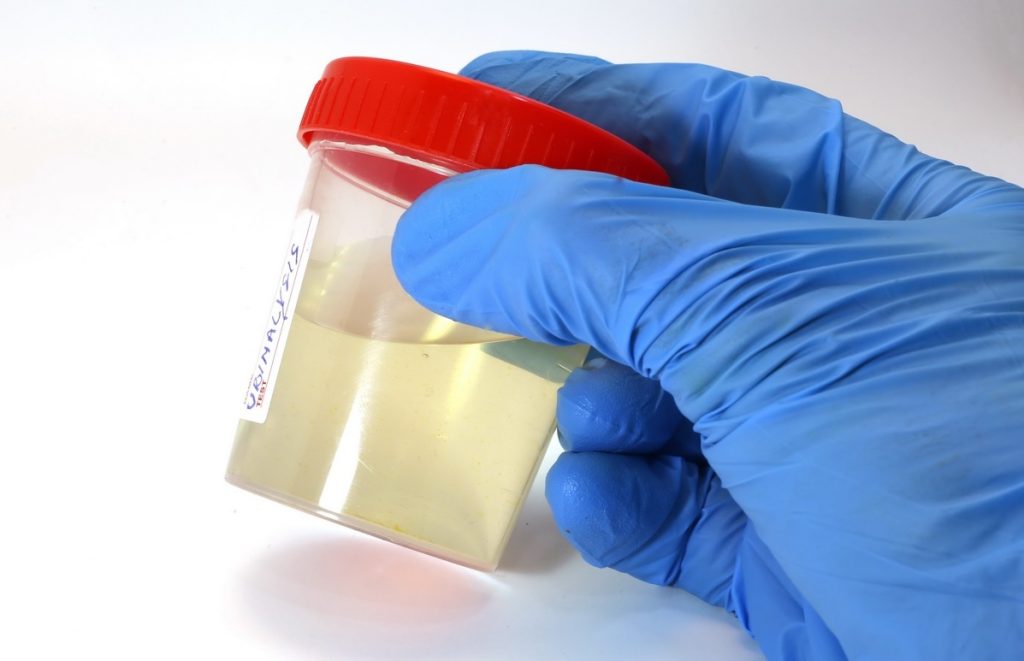 Esterasi Leucocitaria: cos’è, quali sono i valori e quando preoccuparsi