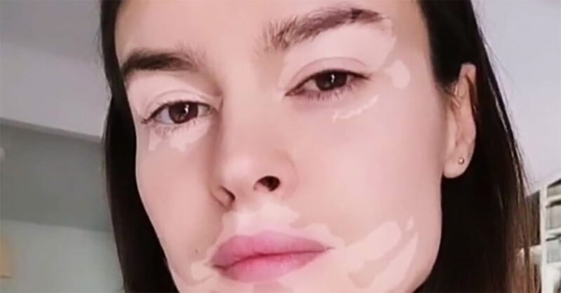 Galleria foto - Kasia Smutniak e la vitiligine: cos’è e come si cura Foto 3