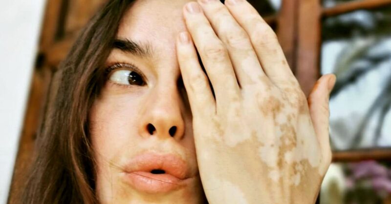 Galleria foto - Kasia Smutniak e la vitiligine: cos’è e come si cura Foto 4