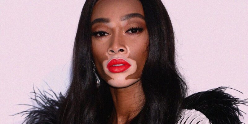 Galleria foto - Kasia Smutniak e la vitiligine: cos’è e come si cura Foto 2